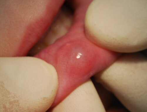ретенционная киста нижней губы фото